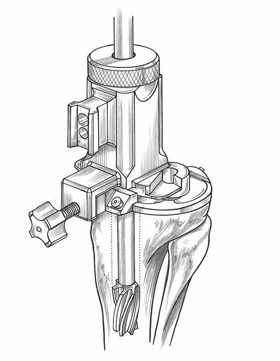 Fig 17 Fig 18 Monogram total knee instruments REAMER BUSHING PEG DRILL DEPTH LEVEL Tibial Preparation: Primary Option It is possible to prepare the tibia for a Modular Rotating Hinge Tibial Baseplate