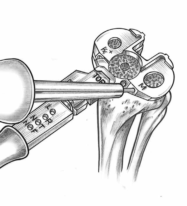 With the knee in full extension, and the Alignment Handle attached to the Template, an Alignment Pin is placed through the "NT" hole position of the handle to verify alignment (Figure 17).
