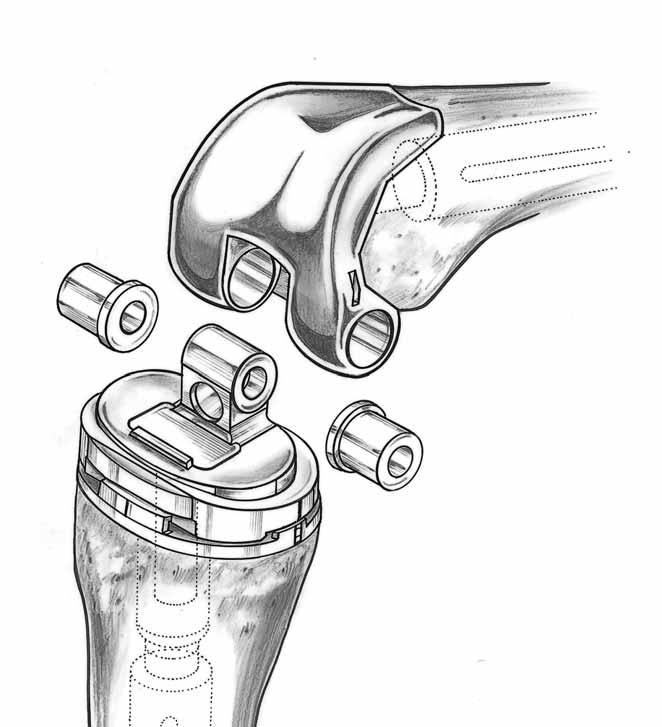 Monogram total knee instruments Fig. 33 Fig. 34 Insert the two Femoral Bushings into the Femoral Component so that the flanges are inside the intercondylar cut out (Figure 33).