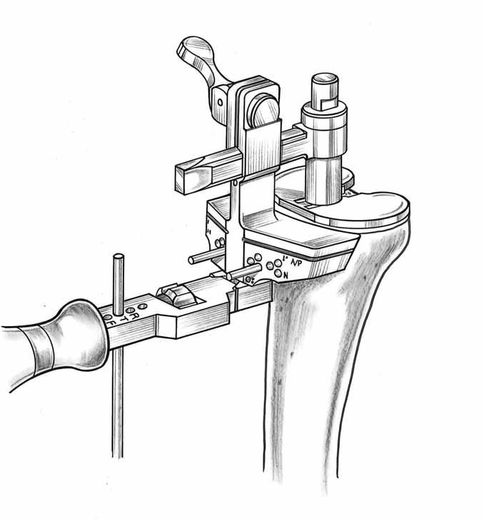 bony aspect of the proximal tibia (Figure 5a). Note: Reamer Depth Gauges for tibial preparation are available in two lengths.