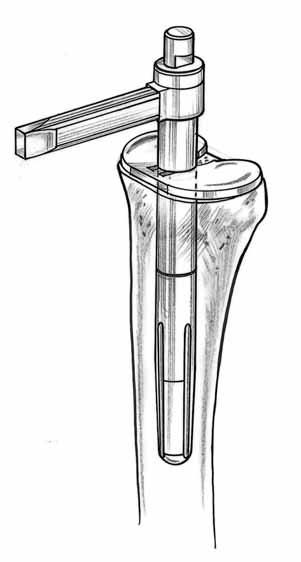 After preparing the medullary canal, the corresponding diameter stem trial is selected and attached to the resection guide tower.