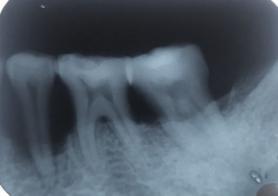 Fig 1 - Intra-oral peri-apical