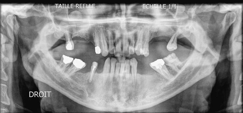 May, 2012 INTERNATIONAL DENTAL JOURNAL OF STUDENT S RESEARCH: CASE REPORT Figure 11: A panoramic radiograph 8 months post surgery suggesting satisfactory bone radiopacity and neoformation Discussion