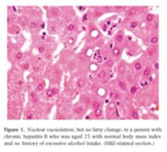 Nuclear Vacuolation in NAFLD Paediatric NASH Children with NAFLD are reported as