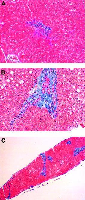 Glycogenic hepatopathy Hepatic adenoma Liver cell cancer Cofactor in other liver