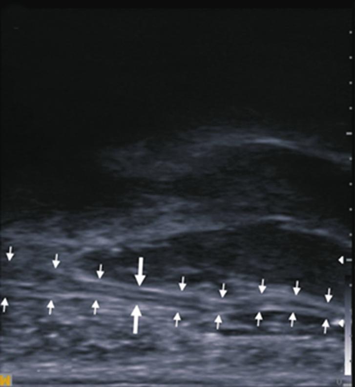 Min Je Kim, et al. Proximal Distal A B Fig. 2. (A) Ultrasonographic evaluation showed compression of right superficial ulnar sensory branch 3.