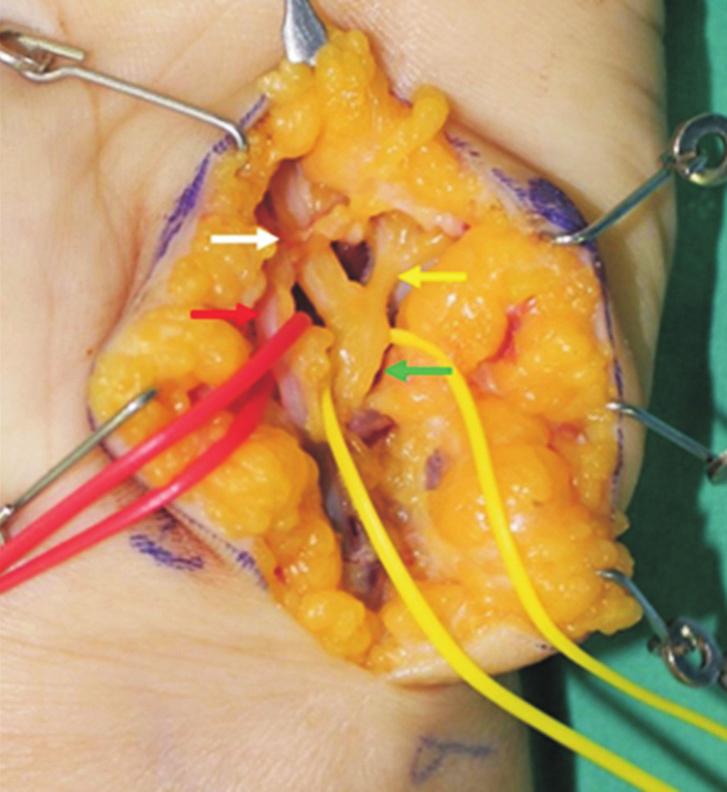 (B) Surgical exploration demonstrated swelling of the superficial sensory branch of the ulnar nerve (white arrow) and fibrotic band-like structure compressing the superficial sensory branch