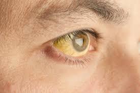 Jaundice and cholestasis Jaundice is the name given to yellowing of the skin and mucosal surfaces due to the presence of bilirubin Many patients with significant liver disease, often severe, are not