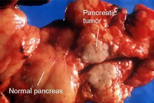 Pancreatic carcinoma The 4 th leading cause of cancer death the United States