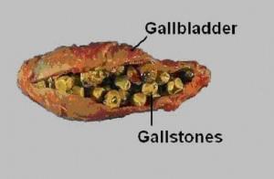 Cholelithiasis Risk factors include female gender, obesity, diabetes melitus Gallstones consist of pure cholesterol, bile pigment, calcium or a mixture Possible mechanism of gallstones may result