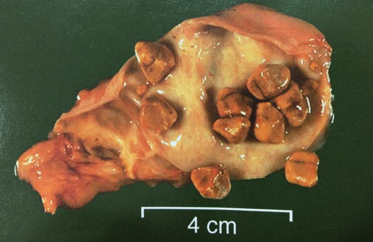 Cholecystitis Acute cholecystitis Usually associated with gallstones Initially sterile, then infected