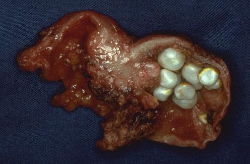 Carcinoma of the gallbladder Gallstones are present in 60% to 90% of cases Most