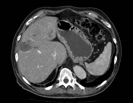 phase Portal phase Complete tumour necrosis after 4 cycles of NGR-hTNF