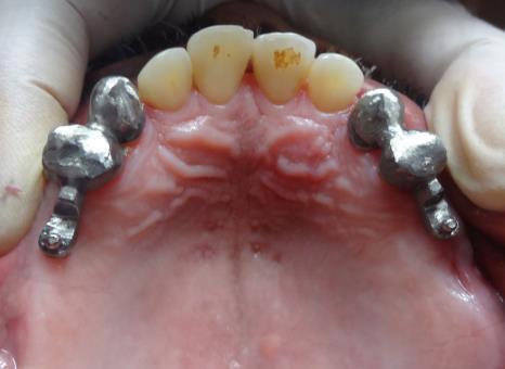 teeth Figure 3: Metal