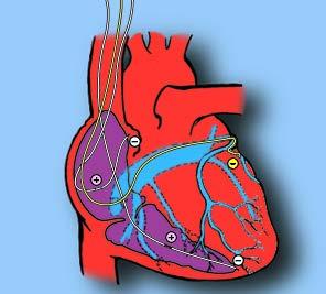 Cardiac Resynchronization Therapy (CRT) Atrial-biventricular stimulation