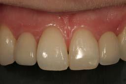 Influence the gingival form Serve as a