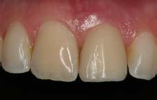 materials How contours affect gingival