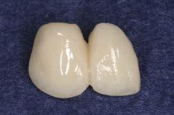 restorations made at the time of implant exposure The cross sectional shape of the abutment at the level of the
