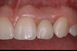 materials How contours affect gingival form