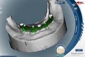 restorations for immediately placed implants