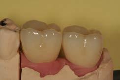 gingival form Temporary