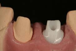 Provisional Restoration of Implants and