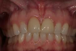 affect gingival form Temporary abutment