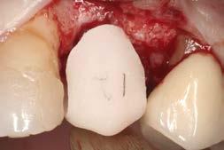 gingival form Temporary