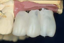 restorations for immediately placed implants