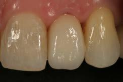 Provisional Restoration of Implants and Abutment