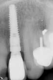 contours affect gingival form Temporary abutment
