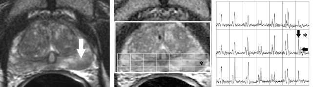 predictor of progression Serial MRI/MRSI (n = 68): MR classed
