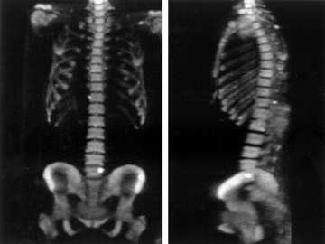 74 Tc-99m SUBTLE NEW LESION CT 7 months before Negative bone scan Dawson,