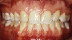 Perio and too old for treatment 25 and considering dentures Cases and concepts Previous tx, but unhappy!