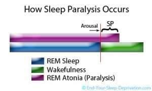Narcolepsy Sleep Paralysis -onset or