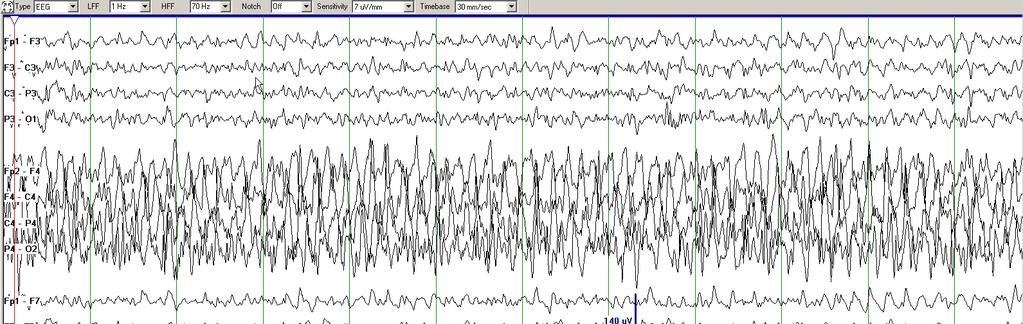 Hirsch MD Interim Summary Electrographic seizures are common after moderate
