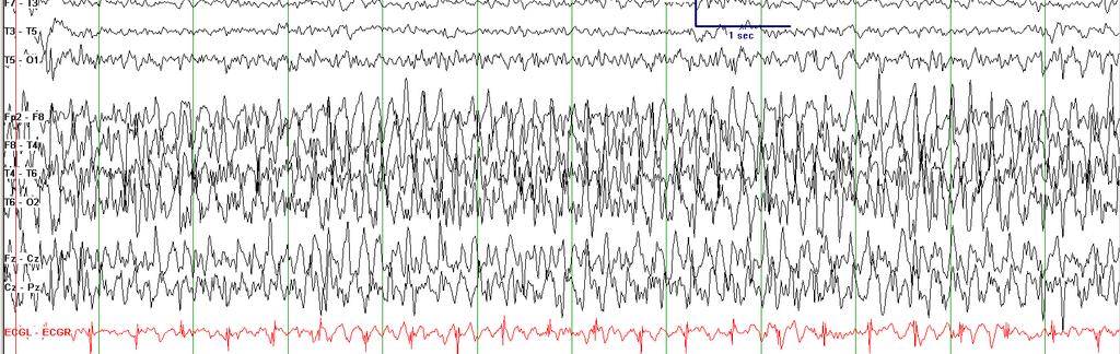 EEG monitoring for 1-2 days Children with a high seizure burden are at risk
