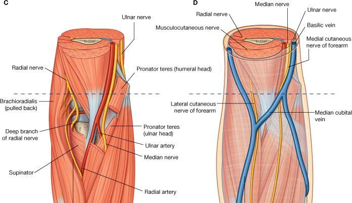Honeymoon palsy (wrist drop) Ulnar nerve Medial cutaneous nerve of forearm Radial nerve Pronator teres Brachioradialis Deep