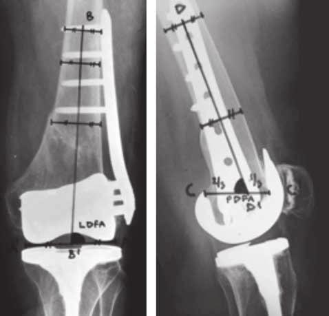 periprosthetic supracondylar femur fractures 419 in the IM nail group than in the locked plate group (Table I). DISCUSSION a b Fig. 1.
