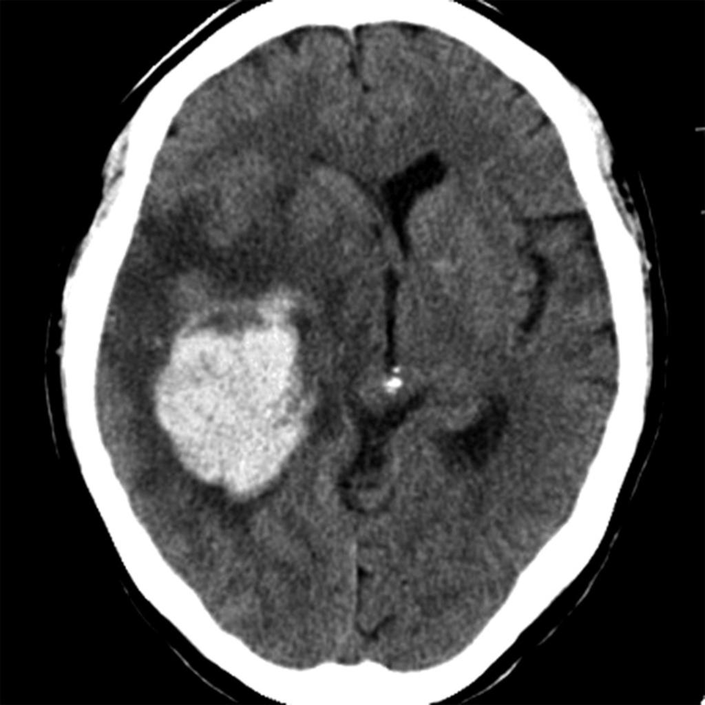 Fig. 8: Intracerebral hemorrhage in a 50-year-old woman.