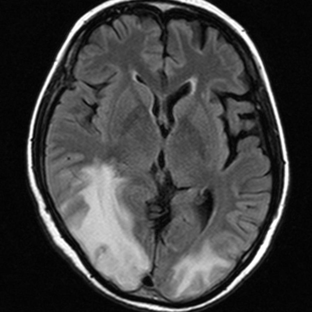 Fig. 9: Posterior reversible encephalopathy syndrome in CNS lupus in a 38-year-old woman.