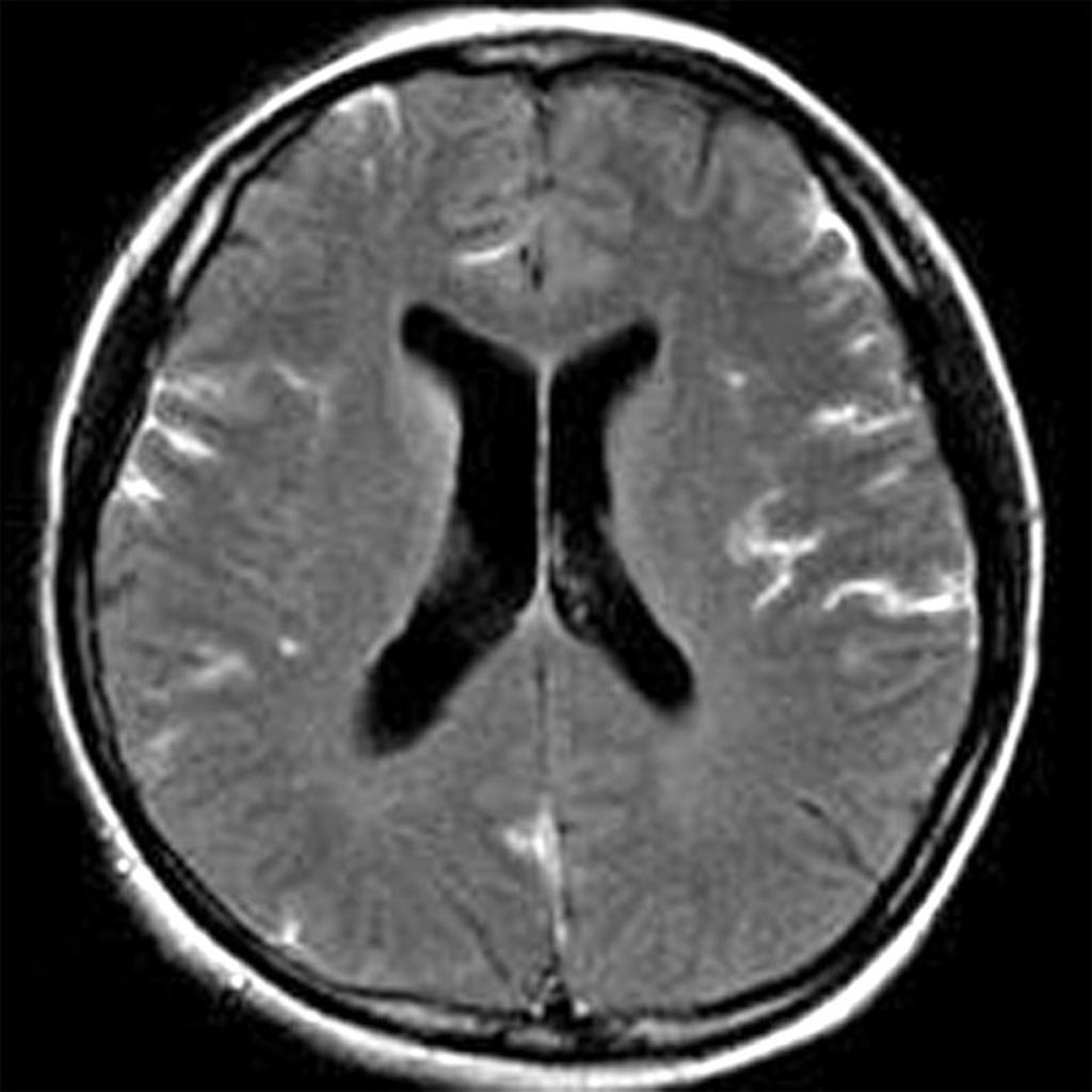 Fig. 2: Aseptic meningitis in a 34-year-old woman. Postcontrast FLAIR shows intense enhancement within sulci.