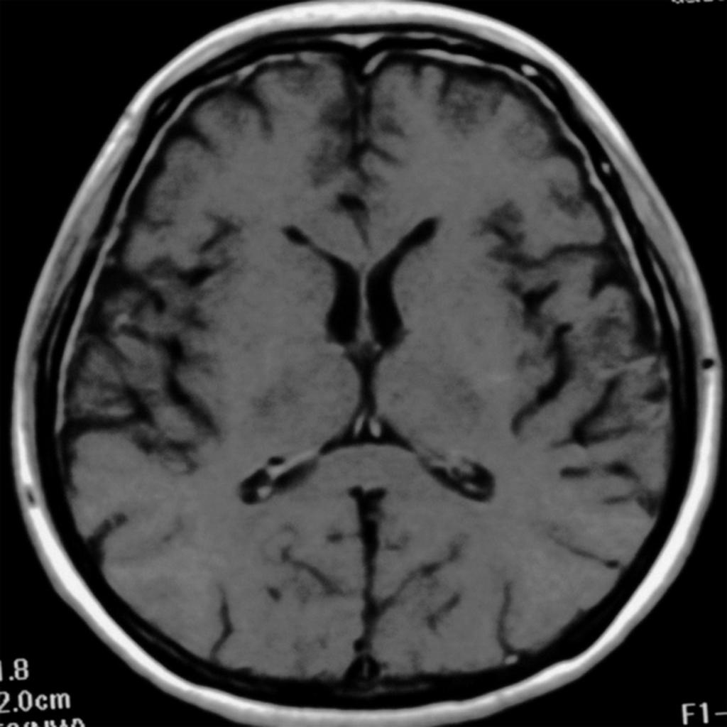 Fig. 3: Thick dural enhancement in a 43-year-old woman.