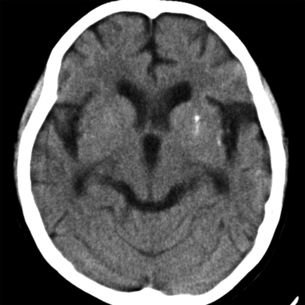 Fig. 4: Brain atrophy in an 18-year-old woman.