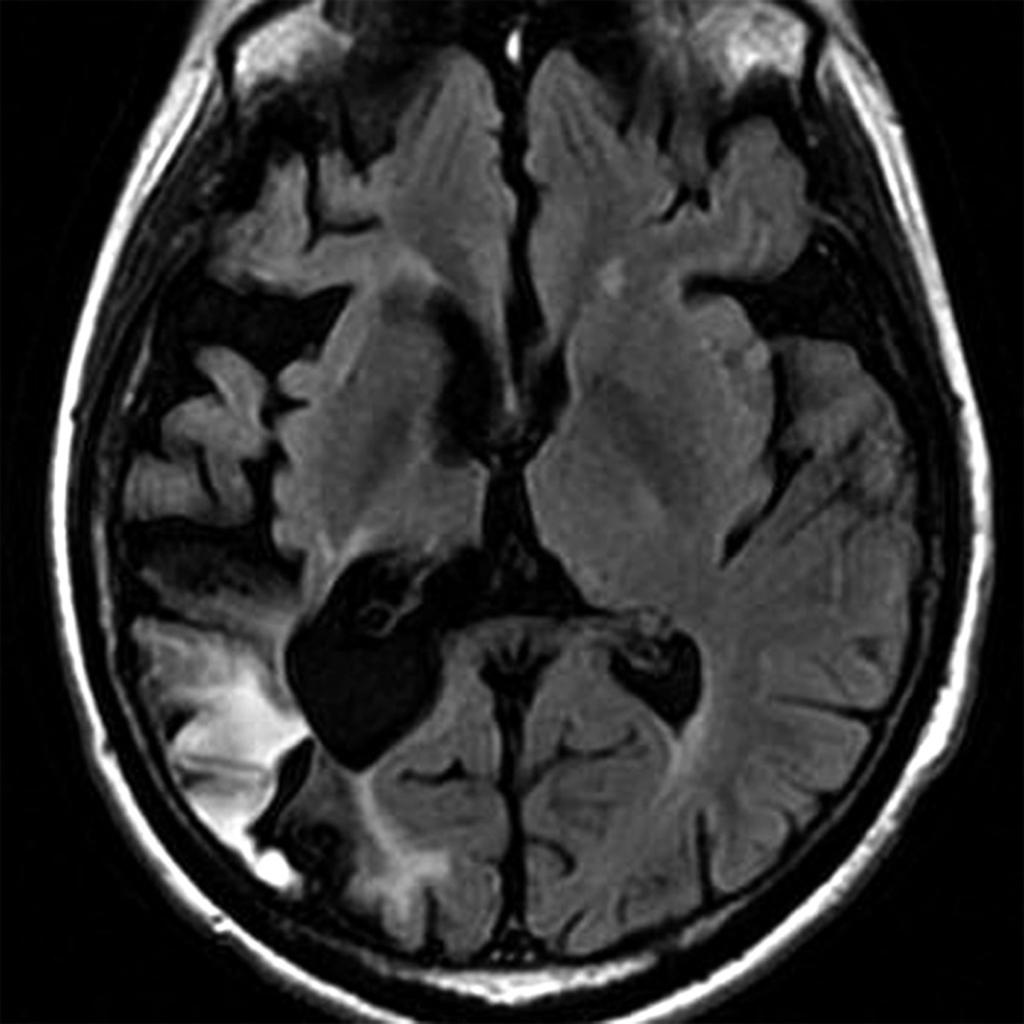 Fig. 5: Old MCA area infarct in a 40-year-old