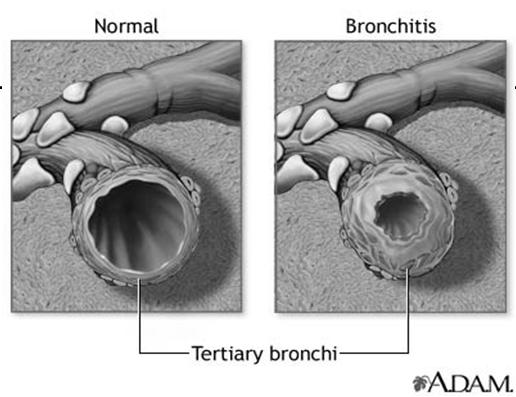 function Increased airway resistance causes bronchospasm Productive