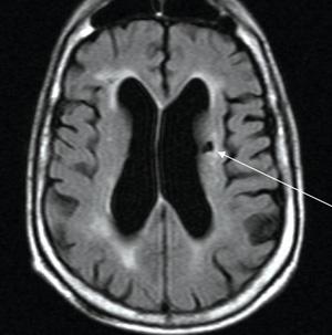 Subclinical Vascular Brain Injury
