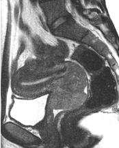 MRI and Carcinoma of the Cervix Squamous carcinoma occurs at the squamocolumnar