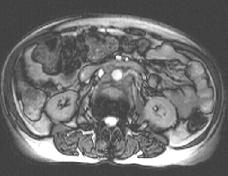 MRI and Endometrial Cancer Why?