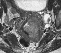 MRI and Endometrial Cancer Depth of